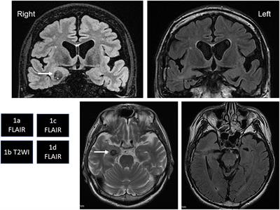 Temporal Lobe Cavernous Malformation Caused Epileptic Amnesic Episodes and Mild Cognitive Impairment